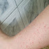 [Relato Pessoal] Manchas Vermelhas na pele: Vasculite, Pitiríase ou Alergia ? 