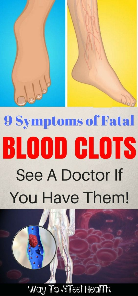 9 Symptoms of Fatal Blood Clots. See A Doctor If You Have Them