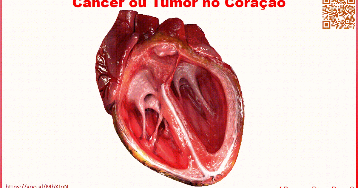 Doenças Raras Doem®: Câncer ou Tumor no Coração brain tumor diagram 