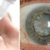 Scientists Have Developed an Eye Drop That Can Melt Away Cataracts