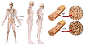 Pengobatan Osteoporosis Secara Tradisional