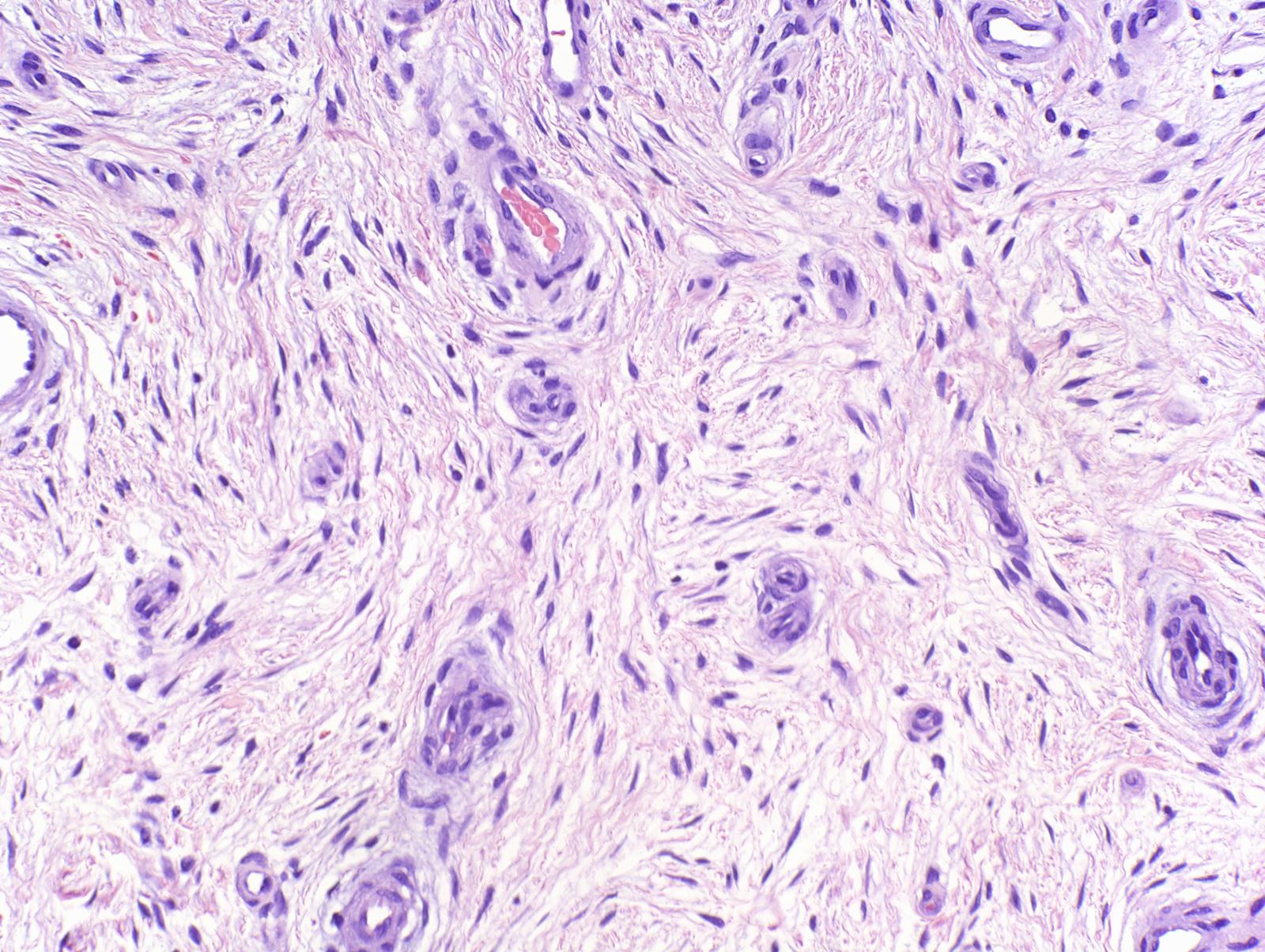 VIRTUAL GRAND ROUNDS IN DERMATOLOGY 2.0 Superficial Acral Fibromyxoma