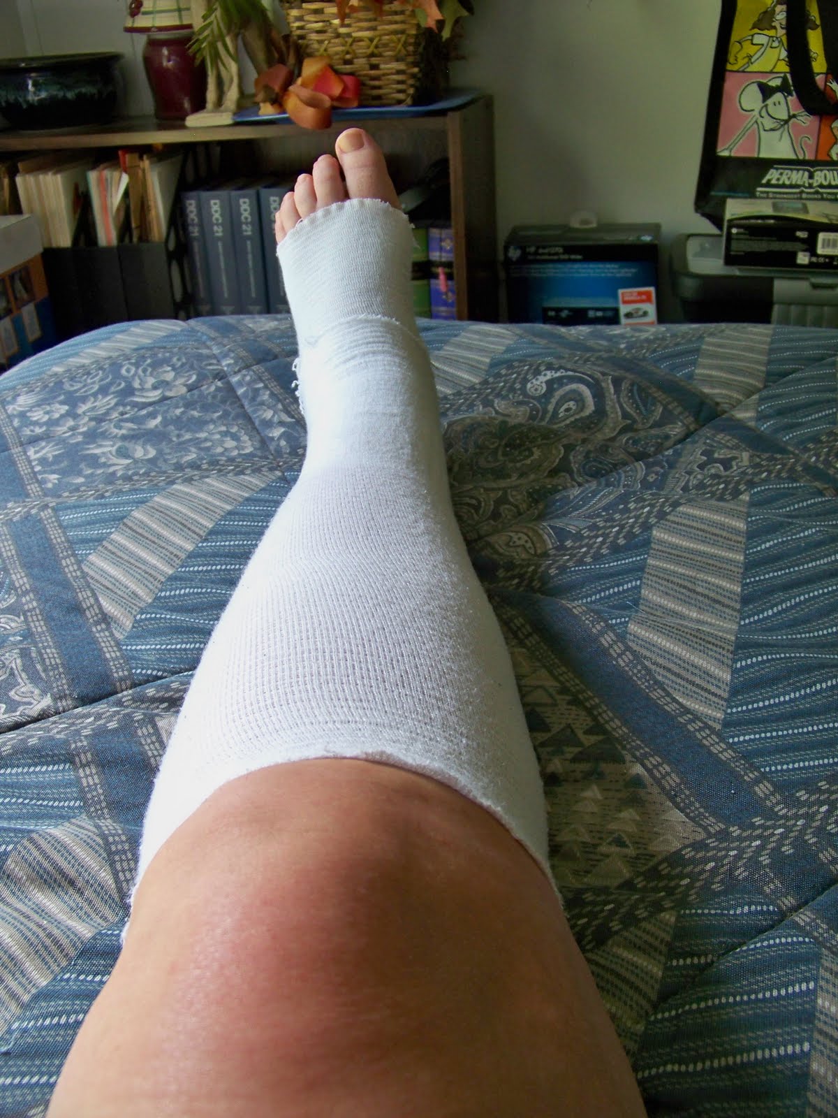 My posterior tibial tendon surgery journey Physical therapy