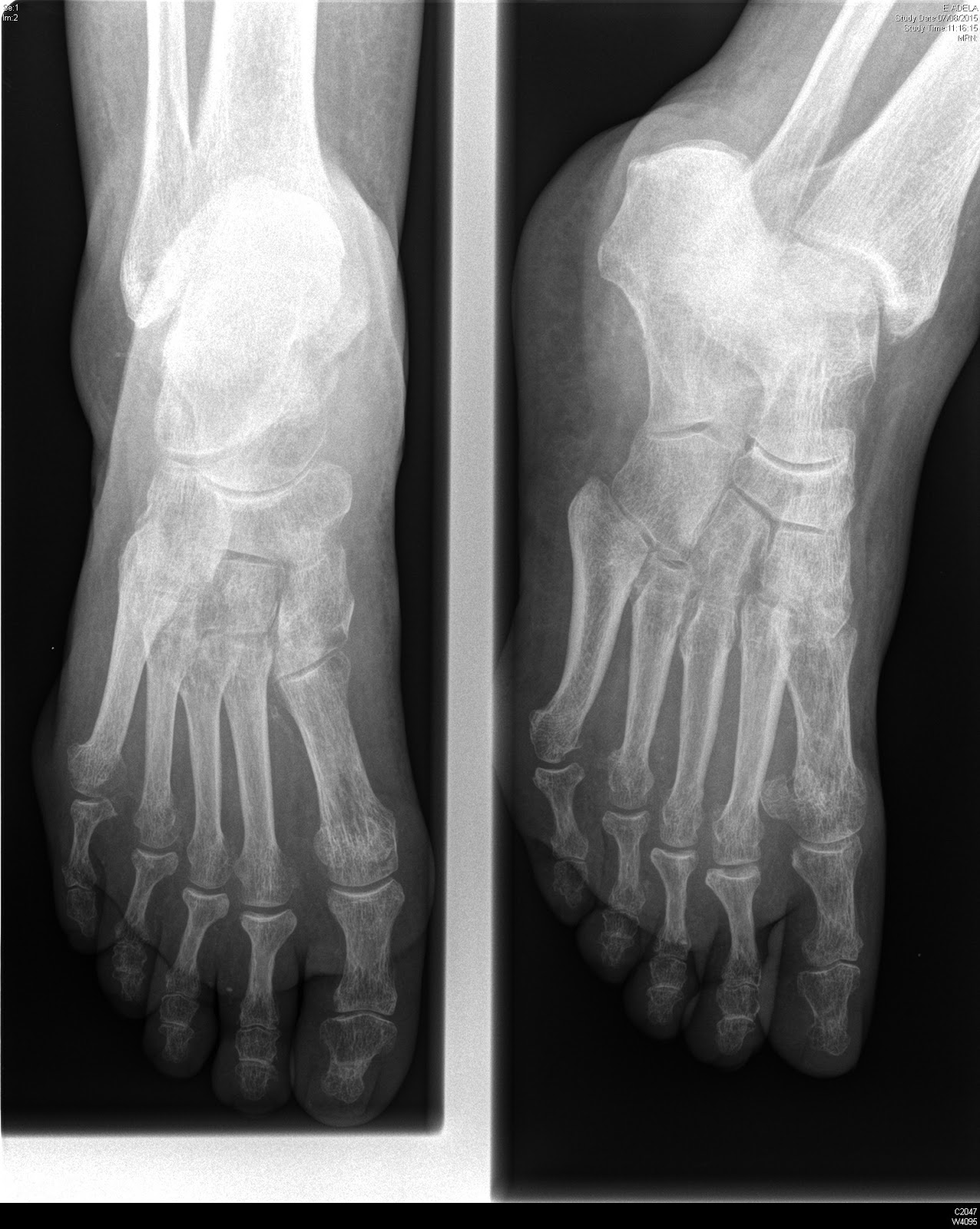 Tecnicos Radiologos: Pie diabético: hallazgos en Diagnóstico por Imagen ...