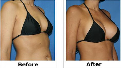 silicone nos seios antes e depois silicone nos seios antes e depois