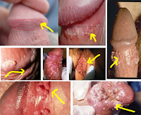 Foto Dokter Kutil Kelamin Jakarta