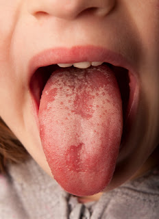 oral thrush mouth