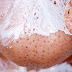 USE THIS SIMPLE AND EFFECTIVE TRICK AND GET RID OF BLACKHEADS