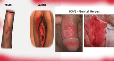 Penyakit Herpes Simpleks Penyakit Herpes Simpleks