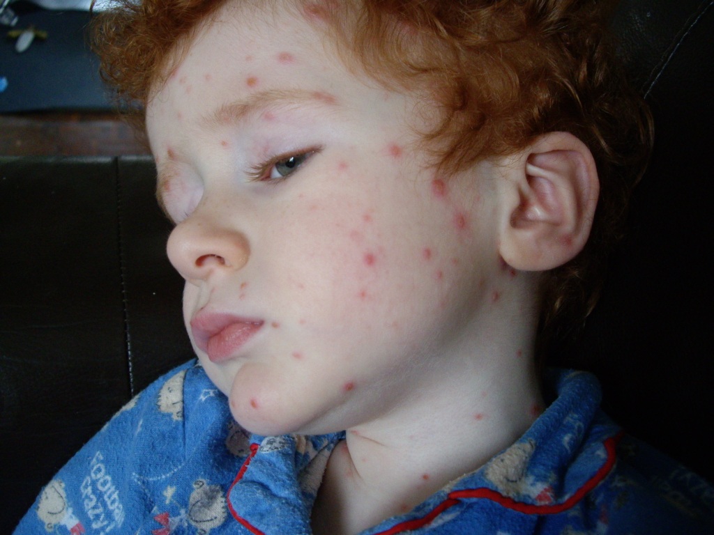 The Brick Castle: Chicken Pox for Beginners....