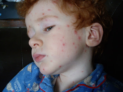 chicken pox spots on face