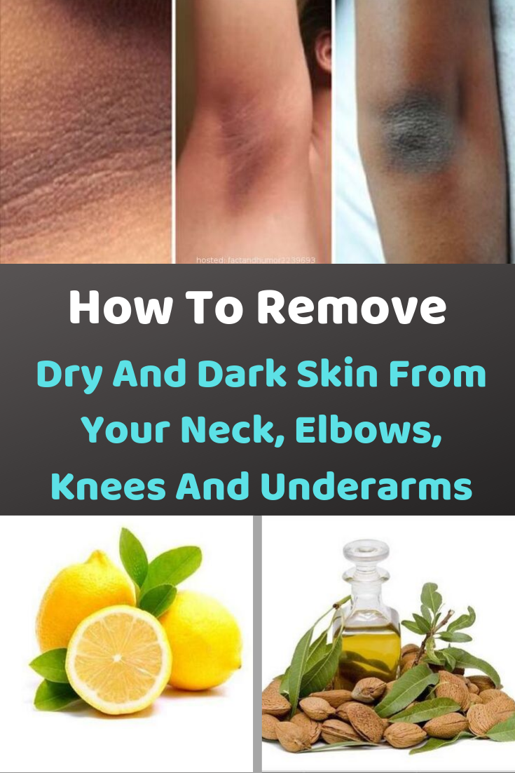 How To Remove Dry And Dark Skin From Your Neck Elbows Knees And Underarms