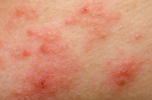 Traitements et recommandations pour lutter contre la rosacée Traitements et recommandations pour lutter contre la rosacée