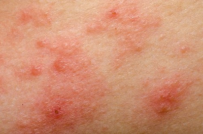 Traitements et recommandations pour lutter contre la rosacée Traitements et recommandations pour lutter contre la rosacée
