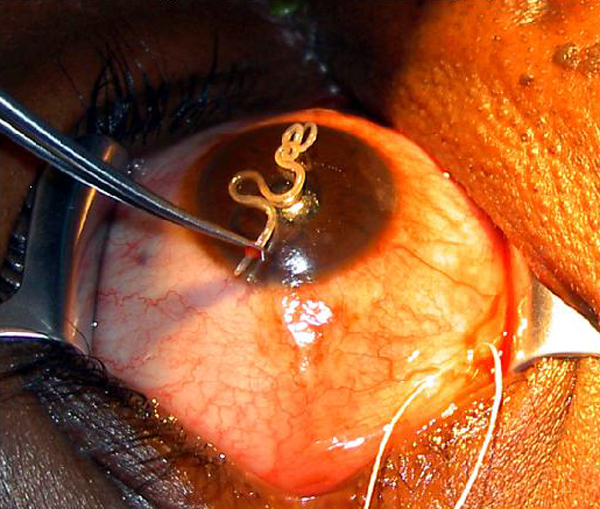 ASK DIS: Treatment of Loiasis (Loa loa infection)