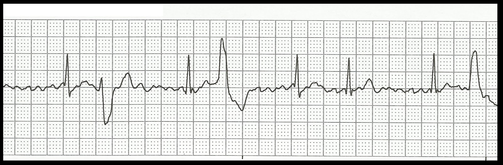 float nurse basic ekg rhythm test 07 med surg nurse