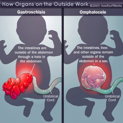 Bagaimana Bisa Seseorang Dilahirkan Dengan Organ Di Luar Tubuh 