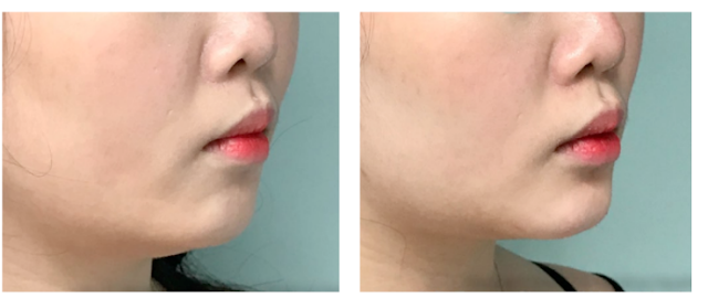 Rejuvenecimiento facial sin cirugía rejuvenecimiento-facial