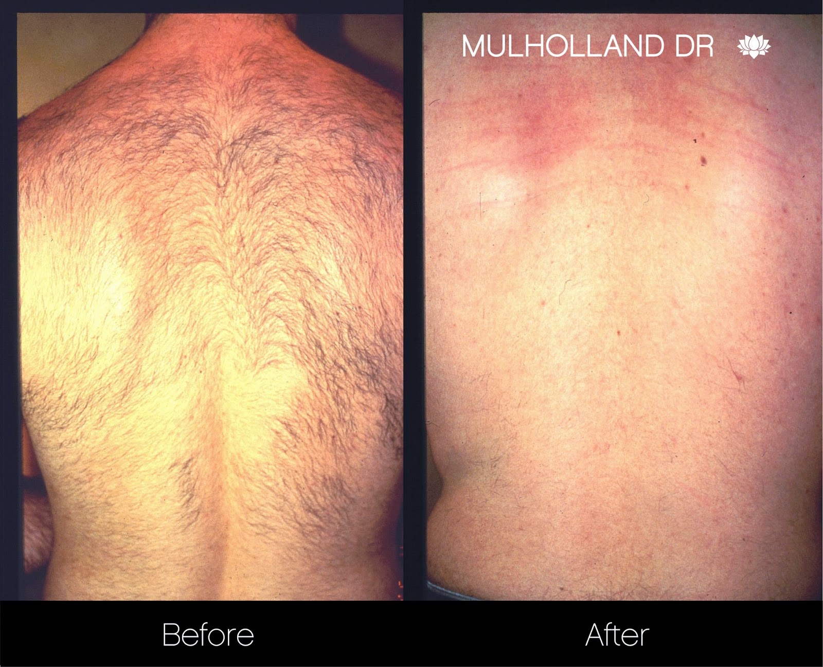 5 Essential Tips About Laser Hair Removal Spamedica