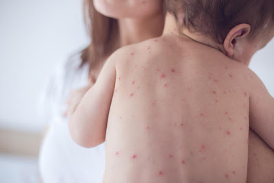 Cara Mengobati Gabagen Pada Bayi 10 Bulan Cara Mengobati Gabagen Pada Bayi 10 Bulan