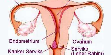 Kanker Serviks Penyebab Kematian Perempuan Indonesia Nomor Satu Kanker Serviks Penyebab Kematian Perempuan Indonesia Nomor Satu