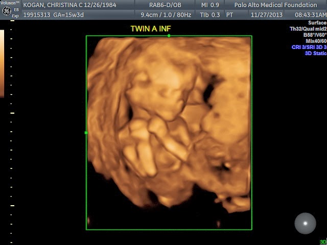 Kogan Twins: 15 week ultrasound