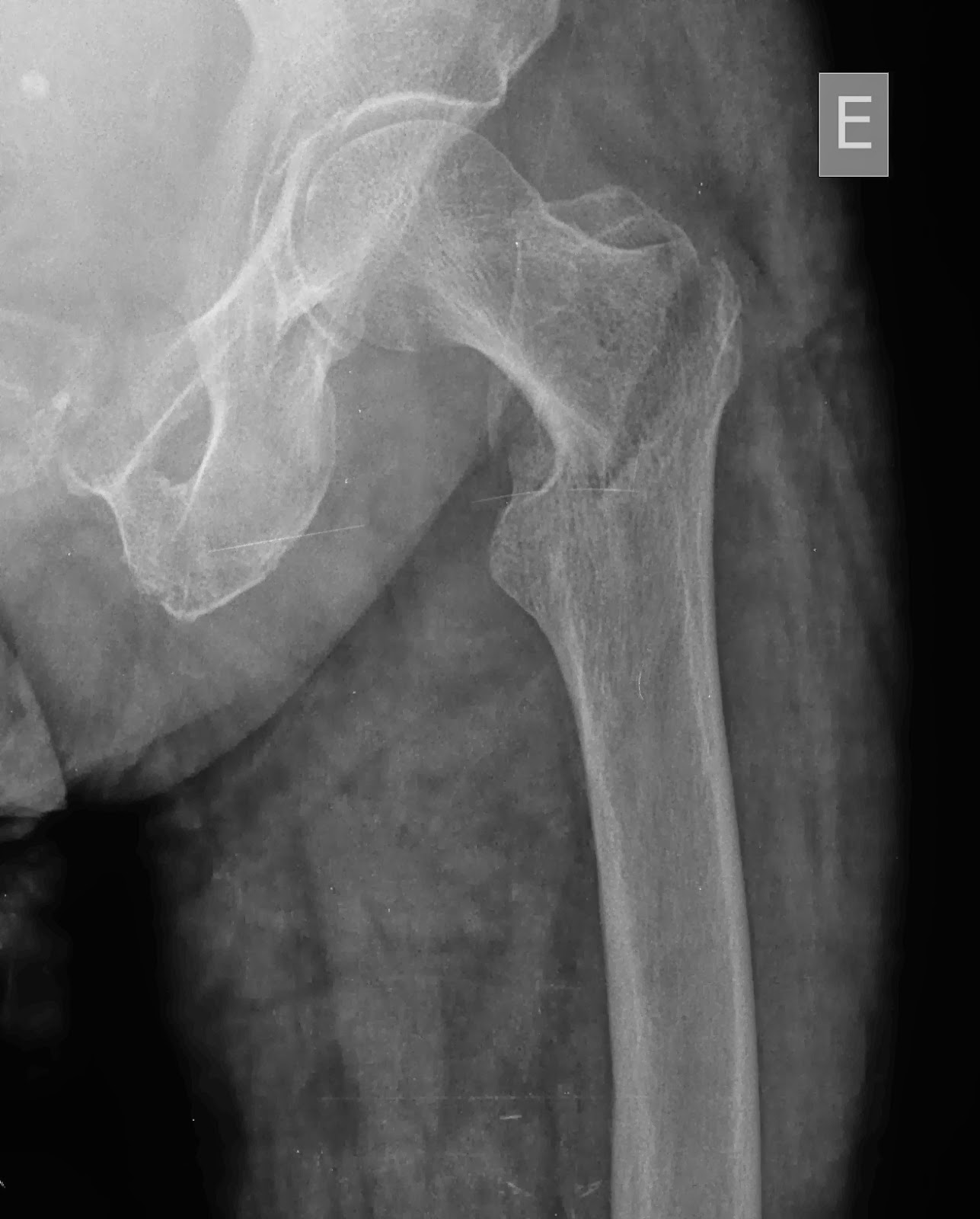 Fractura pertrocantérica do fémur esq e seu tratamento cirurgico Enfermagem em Ortopedia Fractura pertrocantérica do fémur esq e seu tratamento cirurgico Enfermagem em Ortopedia