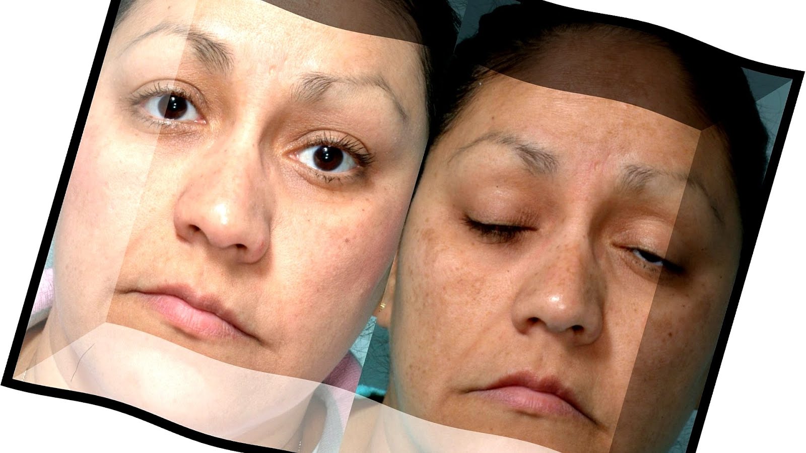 R Chop Chemo Side Effects Effect Choices