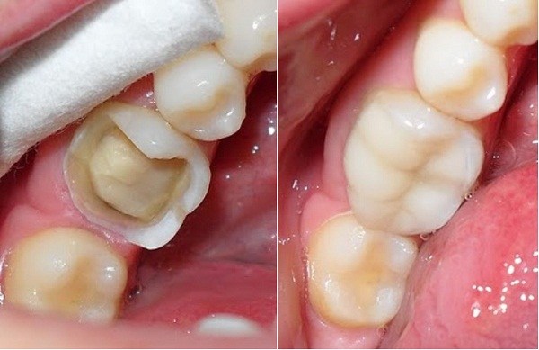 Chăm sóc sức khoẻ: Chức năng của hàn tạm răng bị mất men Rang-ham-vo-lon