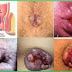 Obat Ambeien Dalam Islam thumbnail