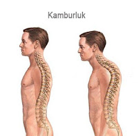 Sırtı normal ve kambur olan iki insan modelindeki omurilik eğriliklerini gösteren çizim