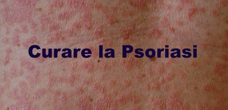 Unguento di psoriasi ormonale