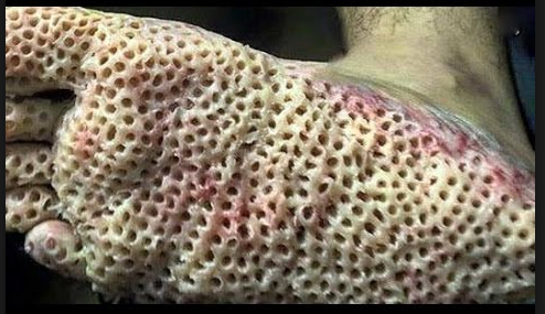 trypophobia parah trypophobia parah