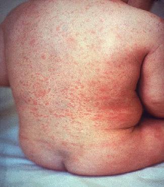 Staph Infections and MRSA in Children: Prevention ...