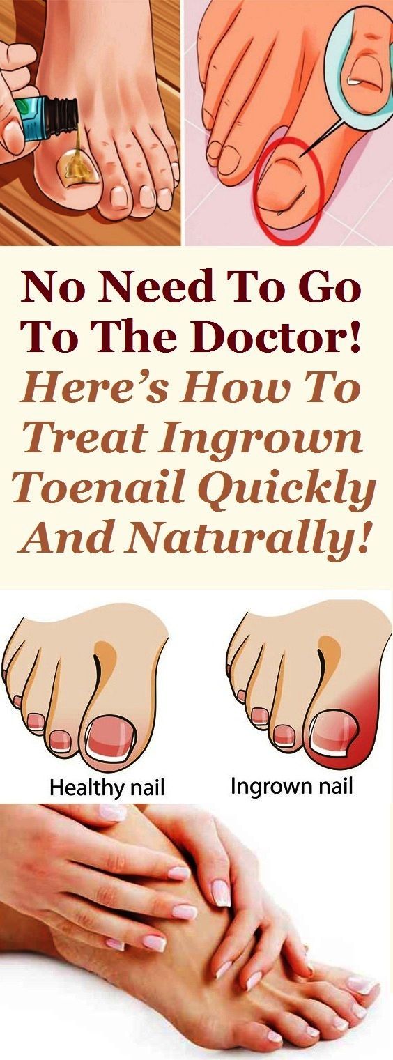 NO NEED TO GO TO THE DOCTOR! HERE’S HOW TO TREAT INGROWN TOENAIL