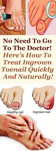 NO NEED TO GO TO THE DOCTOR! HERE’S HOW TO TREAT INGROWN TOENAIL QUICKLY AND NATURALLY!