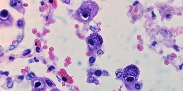 Cara Alami Menghilangkan Virus Torch