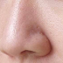 5 Ways to Reduce Enlarged Pores