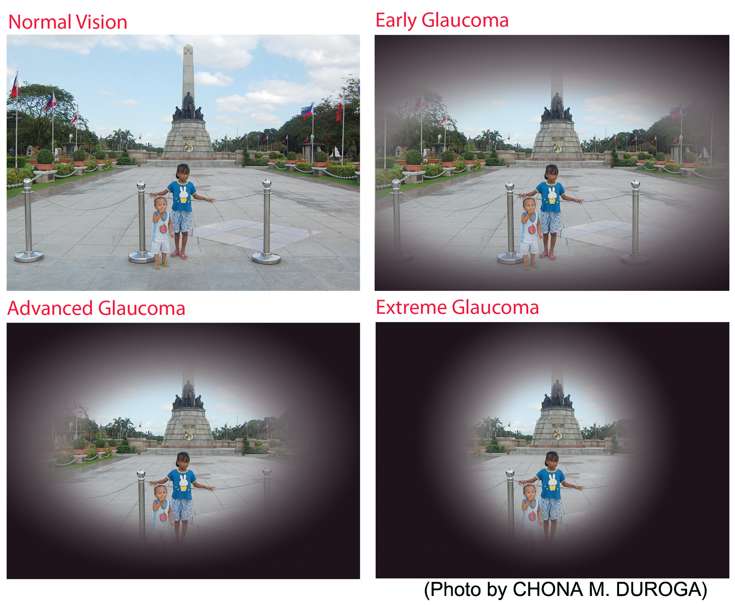 medical-info-glaucoma
