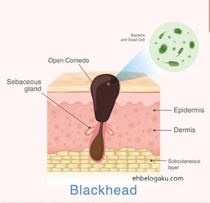 blackhead,blackhead blaster,how to remove blackhead without pain