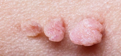 Foto 3 Nama Obat Kutil Kelamin Paling Ampuh Di Apotik