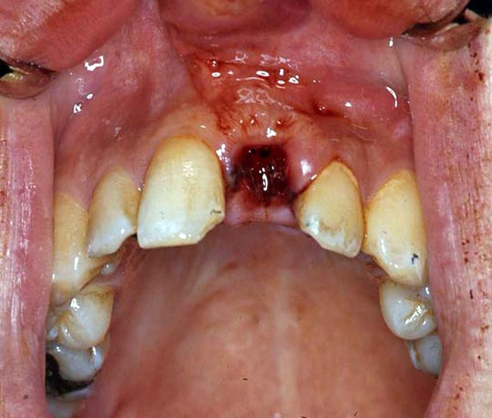 avulsion-dental