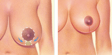 keyhole technique- breast reduction