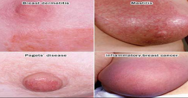 obat herbal abses obat herbal abses