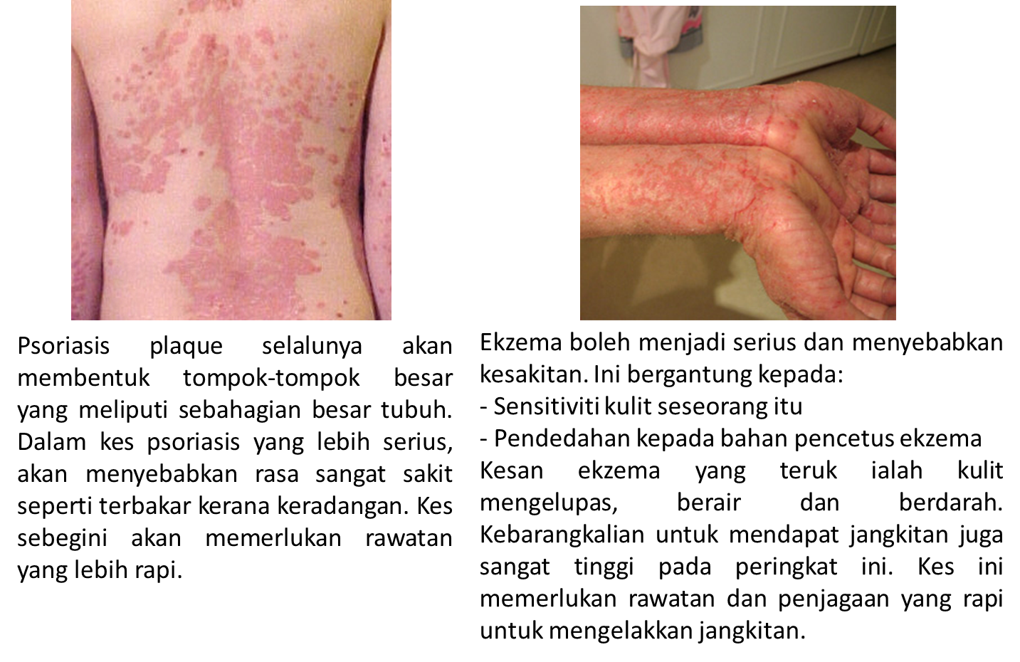 Psoriasis dan ekzema, apa bezanya? Hearty . Love . Healthy