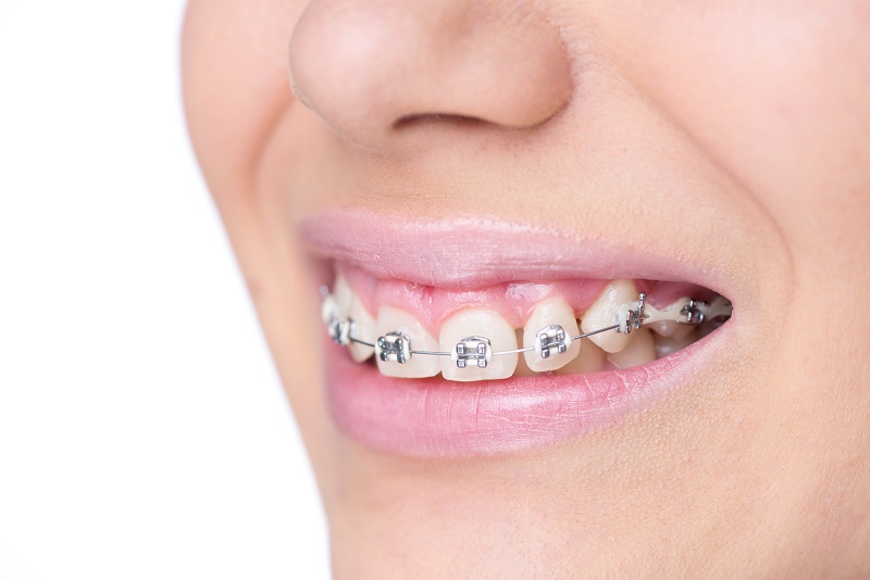 6 Benefits of Invisalign Braces over Traditional Braces for Cosmetic