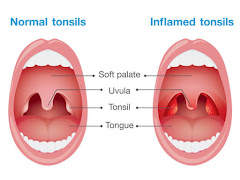 Bahaya Penyakit Tonsil Boleh Meragut Nyawa