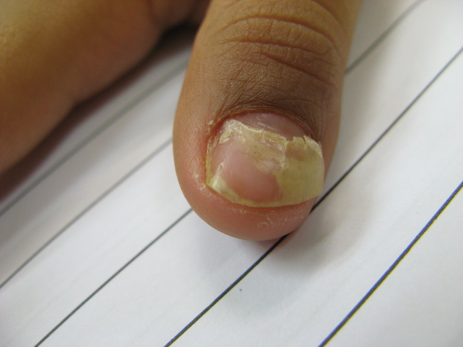 Paediatric Infectious Disease Onychomadesis A common sequalae and