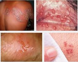 Foto Obat Herpes Pada Alat Kelamin Pria Paling Ampuh yakin sembuh