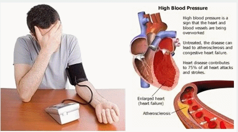 Mengenali Penyakit Darah Tinggi (Hipertensi)